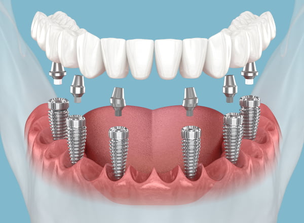 teeth in a day all on x dental implants vs traditional full-mouth implants