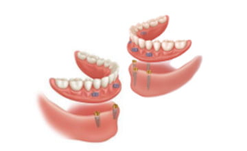 dentures