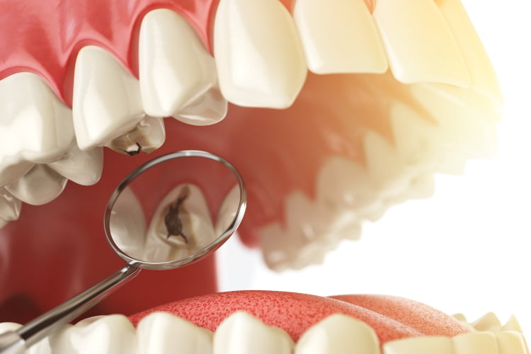Loss of Crown or Fillings