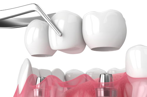 A dental bridge restoration replaces missing teeth as part of prosthodontic treatment.