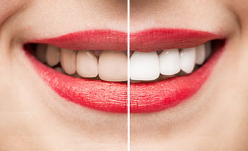 Teeth Whitening