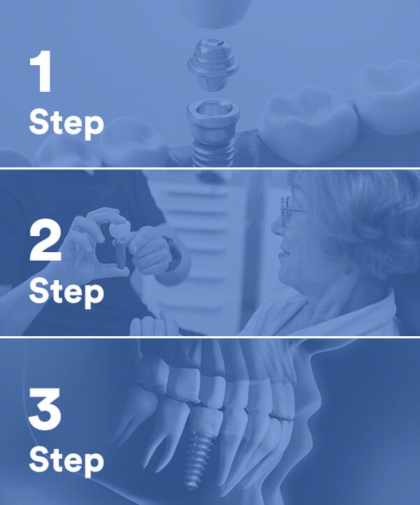 How the Dental Implant Procedure Works