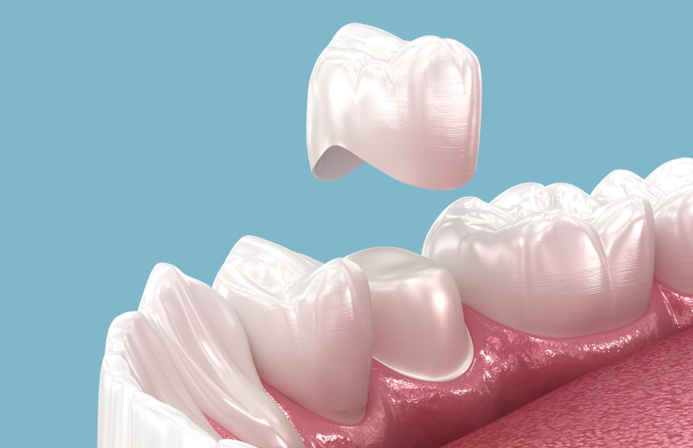 How Much Does a Dental Crown Cost in Ontario?