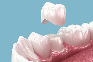 Full Mouth Restoration with Porcelain Crowns: Types, Procedure, and What to Expect