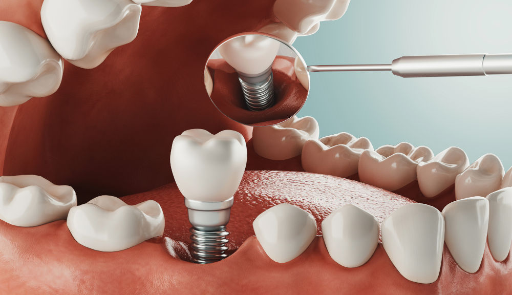 Concept image representing how patients compare dental insurance plans, coverage levels, and costs across Canada.