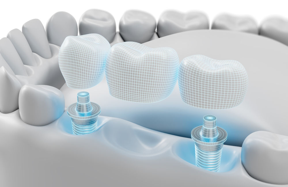 Dental implant and bridge concept showing long-term tooth replacement options