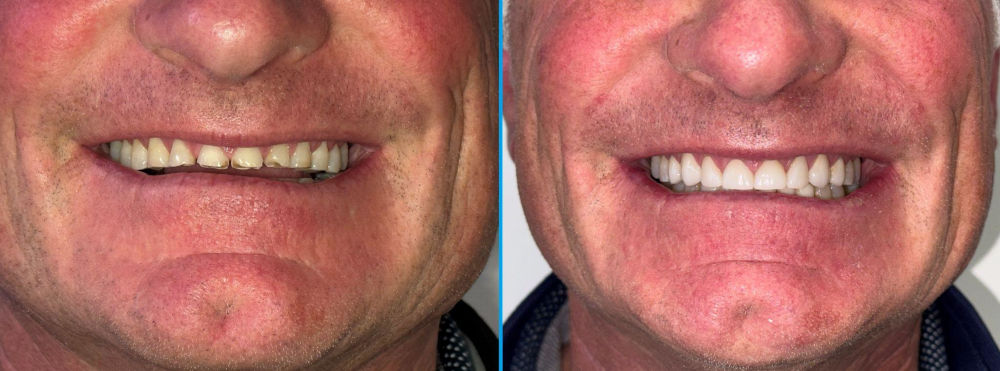 Full mouth restoration before and after at Pickering Smile Centre