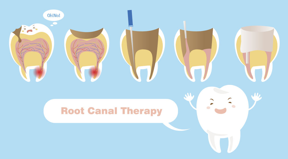 Illustration of root canal therapy showing cleaning and sealing of tooth canals during endodontic treatment.