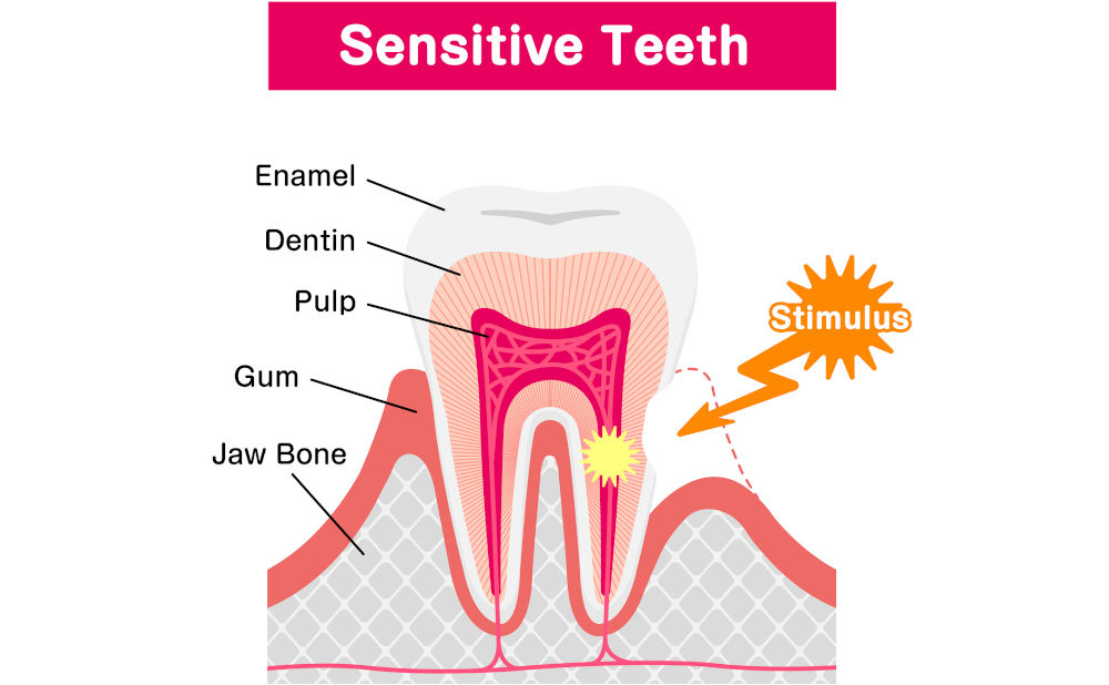 Diagram showing dentin tubules and nerve response causing tooth sensitivity to cold